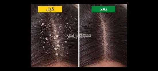 القشرة محرّجتك؟ 😳 شامبو ضد القشرة (تنظيف عميق) – عرض 3 عبوات بسعر خاص 🔥