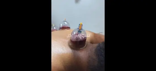 الحجامة الإسلامية وجلسات المساج الاسترخائي و الفوطة النارية - 2