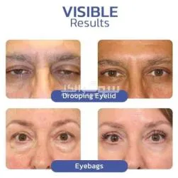 كريم التخلص من تجاعيد منطقة العين"